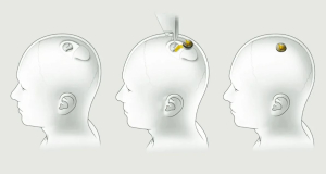 У чипа Neuralink возникла проблема: Kомпания знала об этом еще до имплантации в человеческий мозг