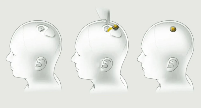 Первый пациент с чипом Neuralink уже управляет компьютерной мышью силой мысли, сказал Маск