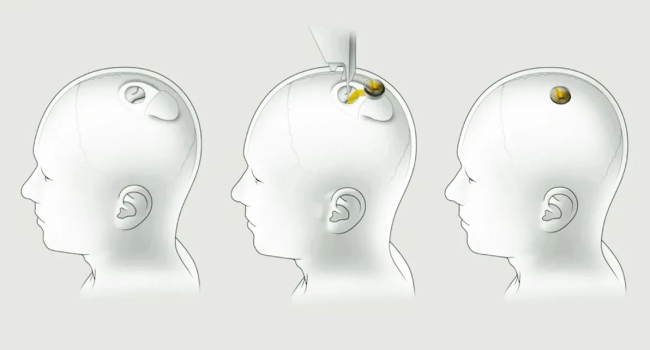 У чипа Neuralink возникла проблема: Kомпания знала об этом еще до имплантации в человеческий мозг