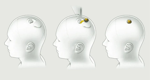 Первый пациент с чипом Neuralink уже управляет компьютерной мышью силой мысли, сказал Маск