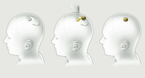 Маск заявил, что Neuralink вернет людям зрение