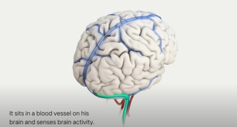 Synchron integrates ChatGPT with human brain