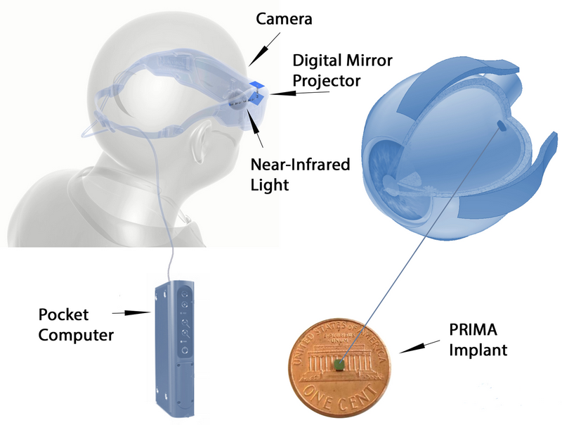 prima_implant_01.png (243 KB)